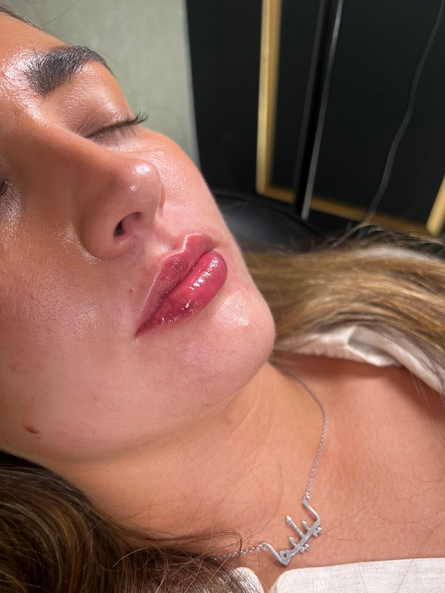 Lip augmentation result